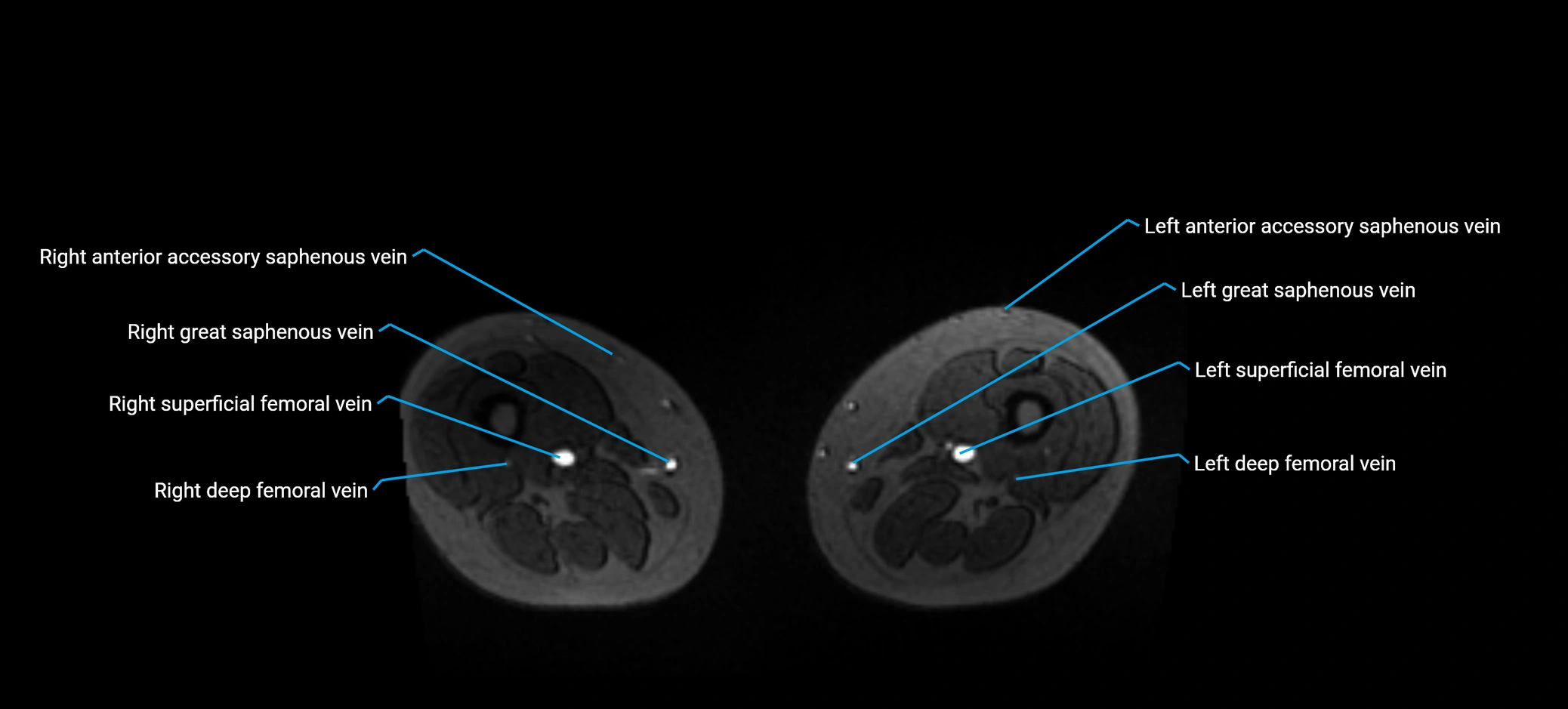 MRV abdomen pelvis & lower limb axial cross sectional anatomy labelled MRI image 300.webp